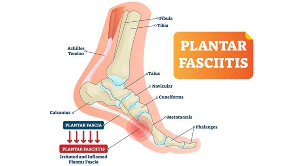 Fasciite plantaire