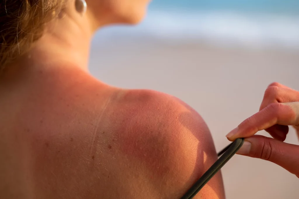 does red light therapy help sunburn