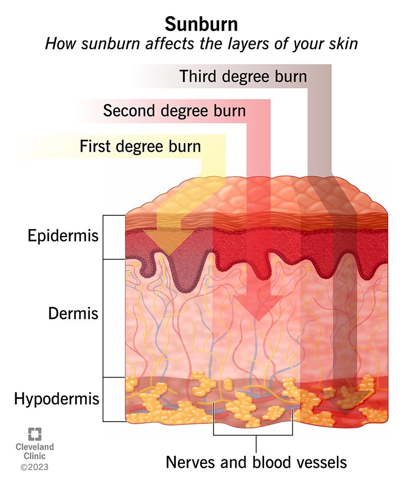 what is sunburn