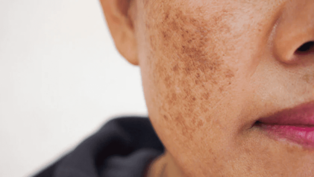Can a red light therapy bed eliminate pigmentation