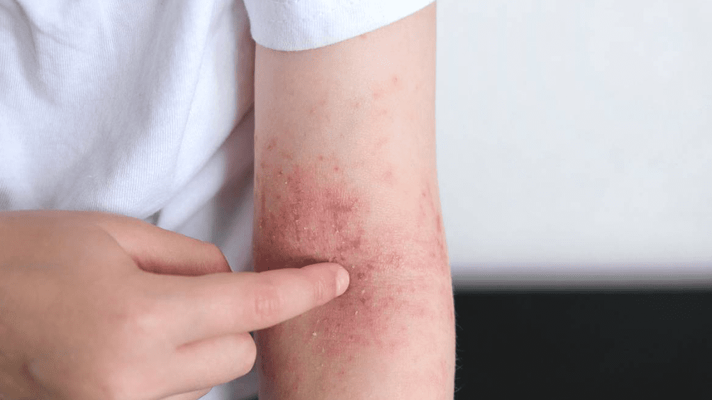 Can red light therapy treat eczema