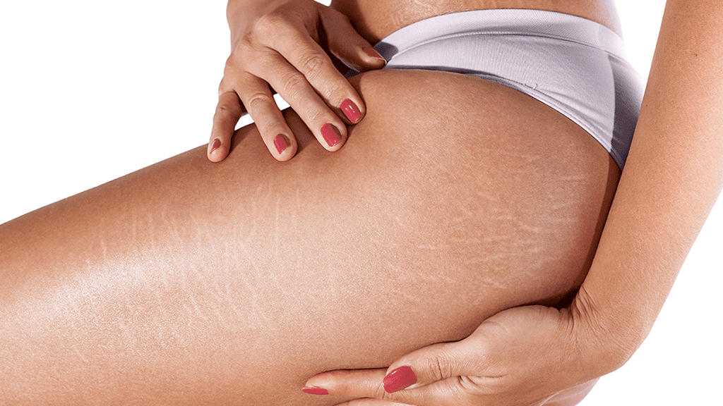 Does Red Light Therapy Help Get Rid of Stretch Marks