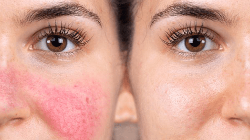 Can Red Light Therapy Help Rosacea