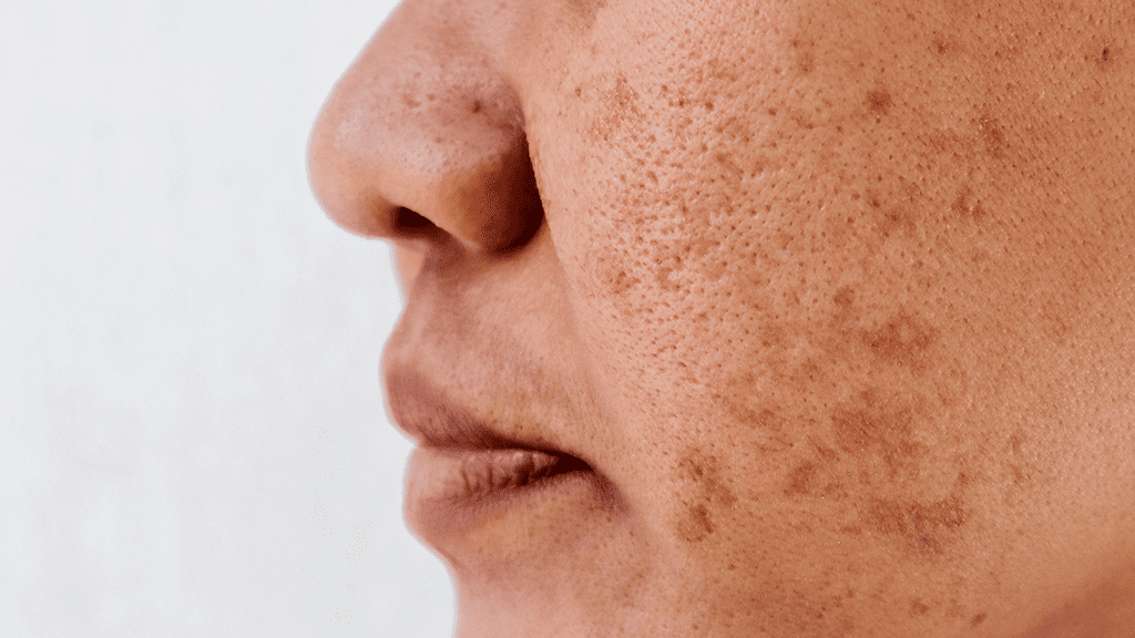 can red light therapy make melasma worse