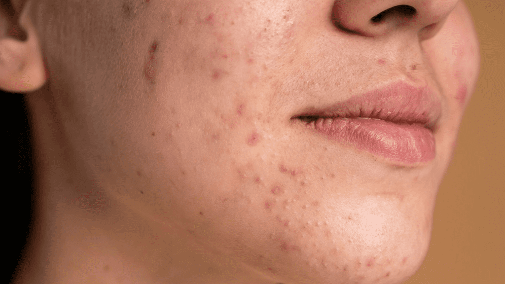does red light therapy cause hyperpigmentation