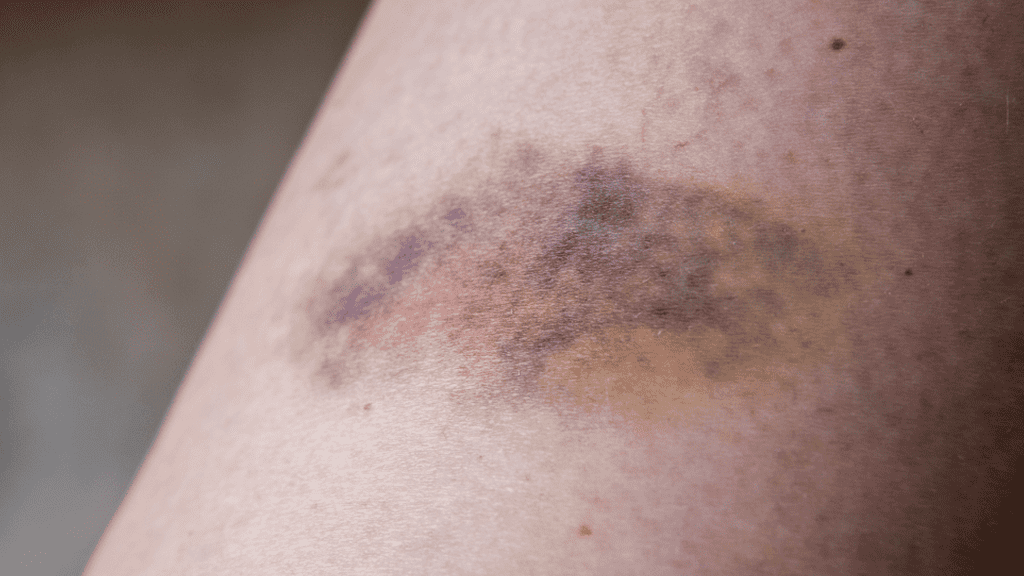 does red light therapy help bruises