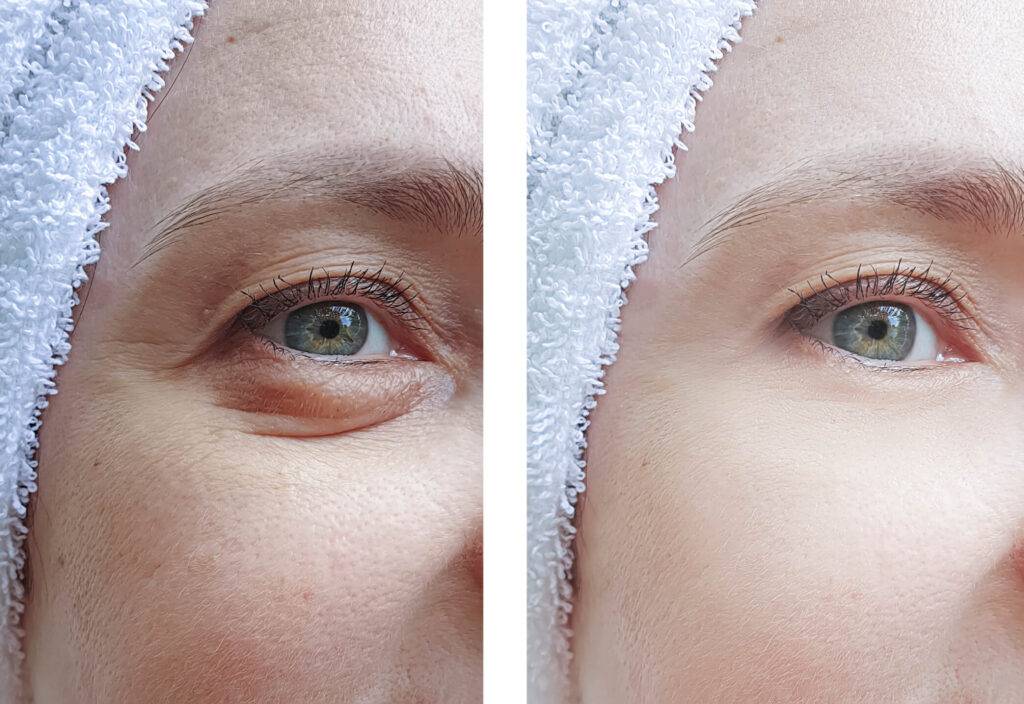 woman puffy eyes before after