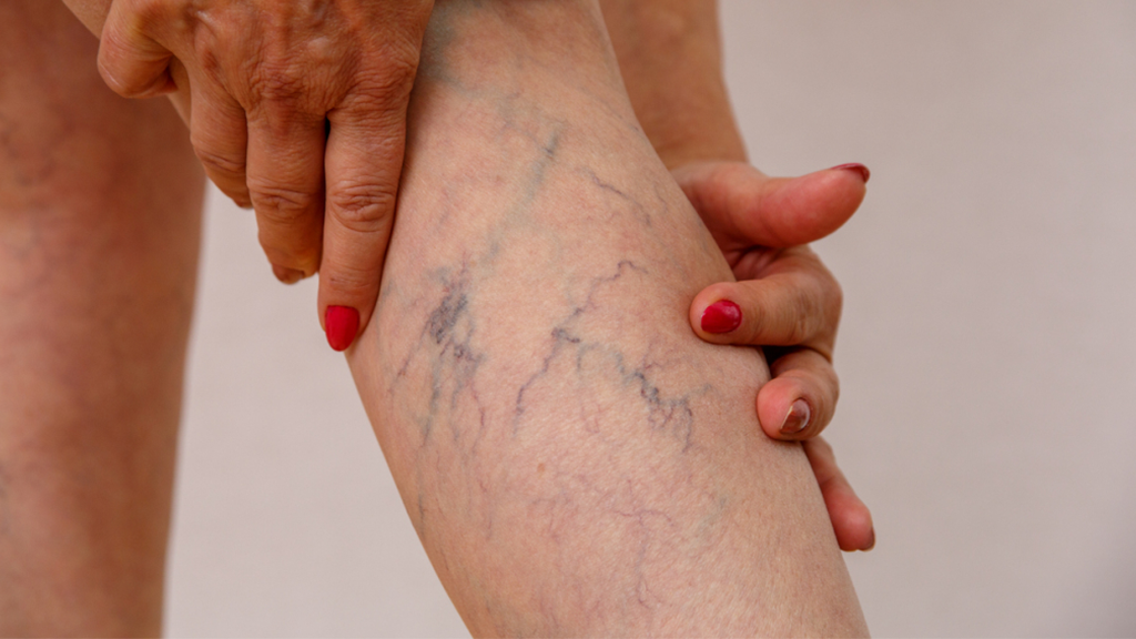 ¿Puede la terapia de luz roja ayudar con las venas varicosas una guía completa?