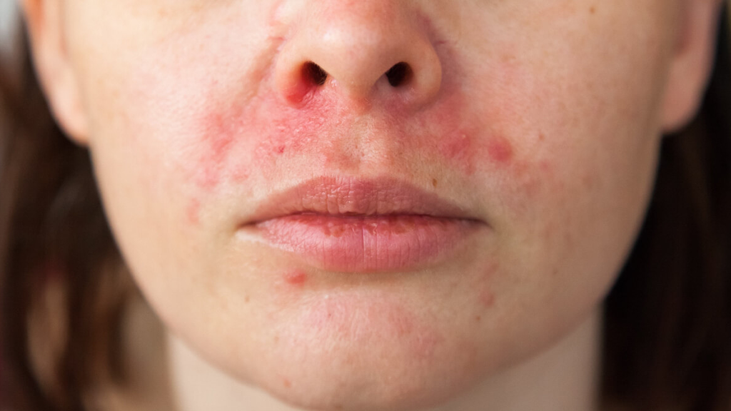 red light therapy perioral dermatitis​