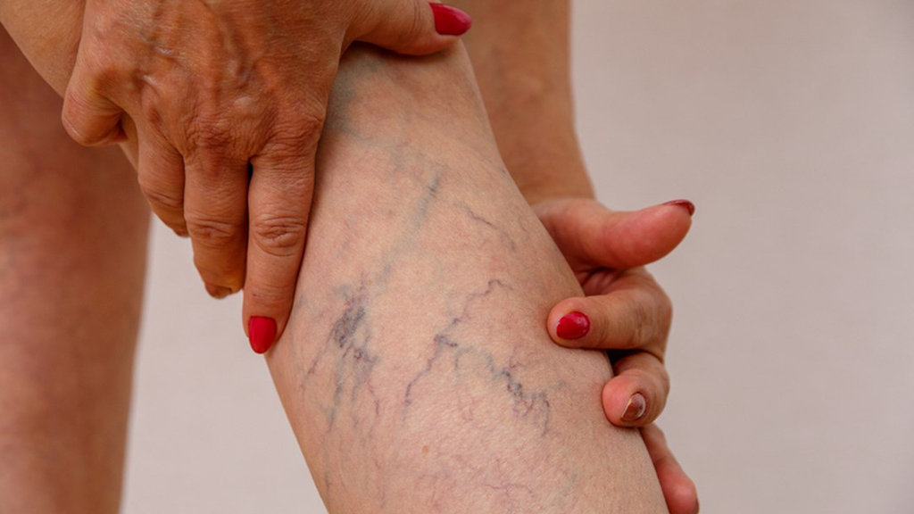FAQ – Red Light Therapy & Spider Veins