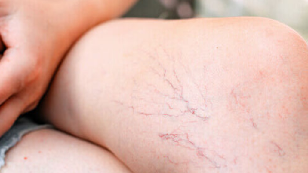 Is Red Light Therapy Good for Spider Veins Improve Circulation and Reduce Vein Visibility