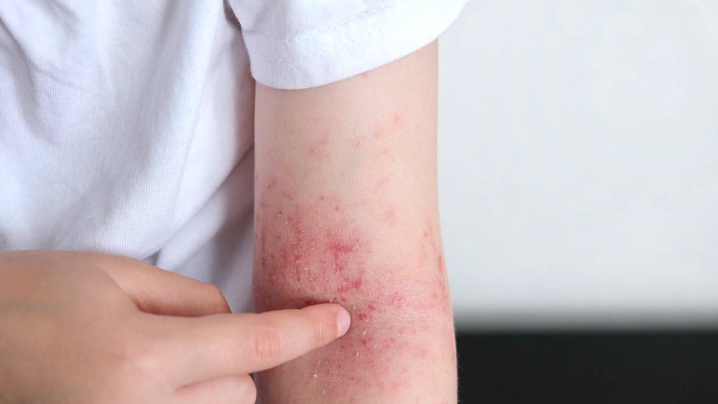 Red Light Therapy and Eczema Care 10 Key Questions You Need to Know